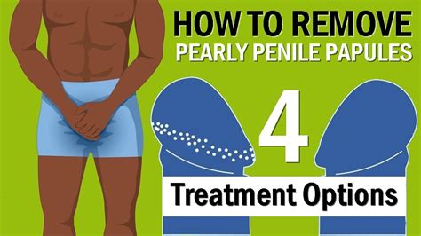 papule perlee penis|Penile Papules: What Are They and How Do They。